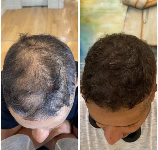 How Can I Hide My Scalp With Thin Hair how-can-i-hide-my-scalp-with-thin-hair