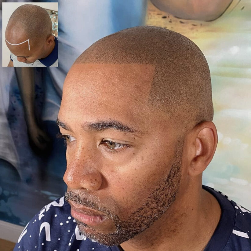 scalp pigmentation