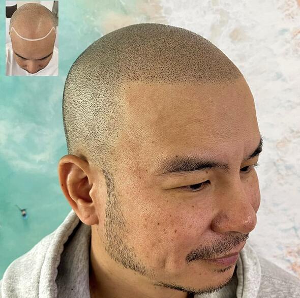 Navigating Scalp Micropigmentation Regrets: Expert Advice