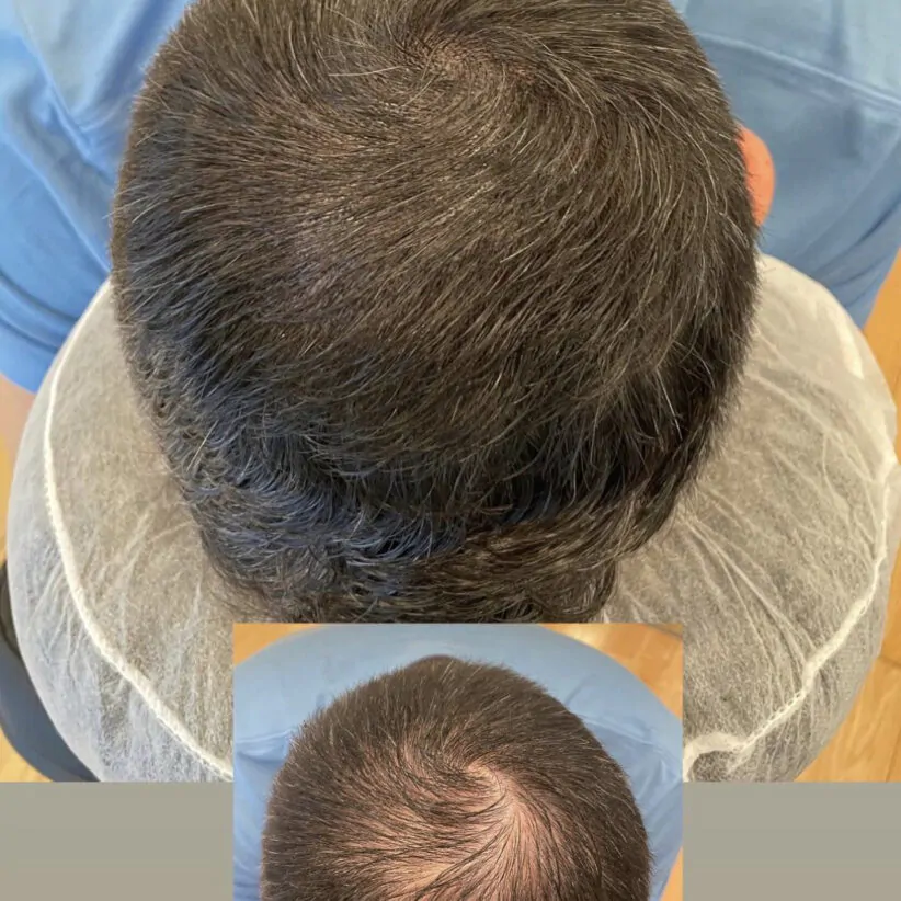 scalp micropigmentation for hair density