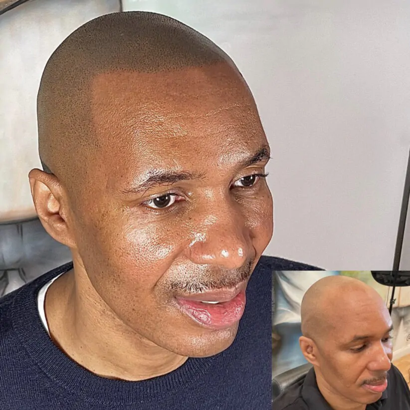 scalp micropigmentation nyc