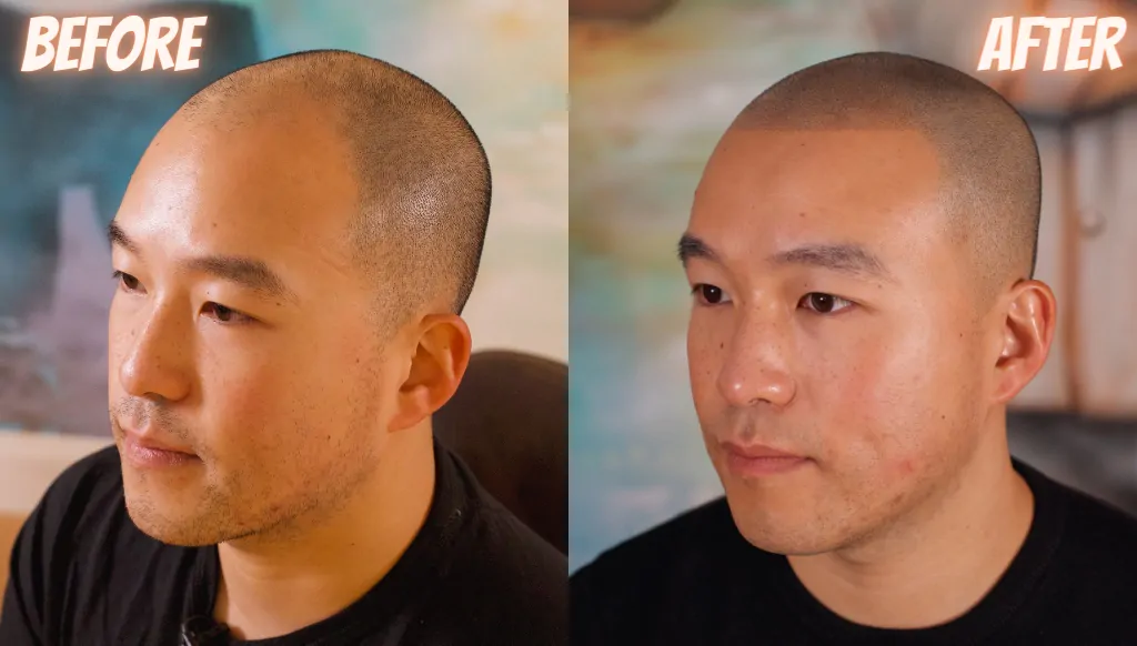 Bobbys Must See Hairline Restoration - SMP Results