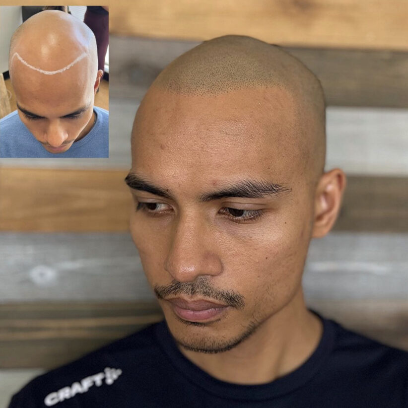 Scalp-micropigmentation-hair-loss-treatment-before-after-photo-micropigmentation-hair-tattoo-houston-texas-tx-1