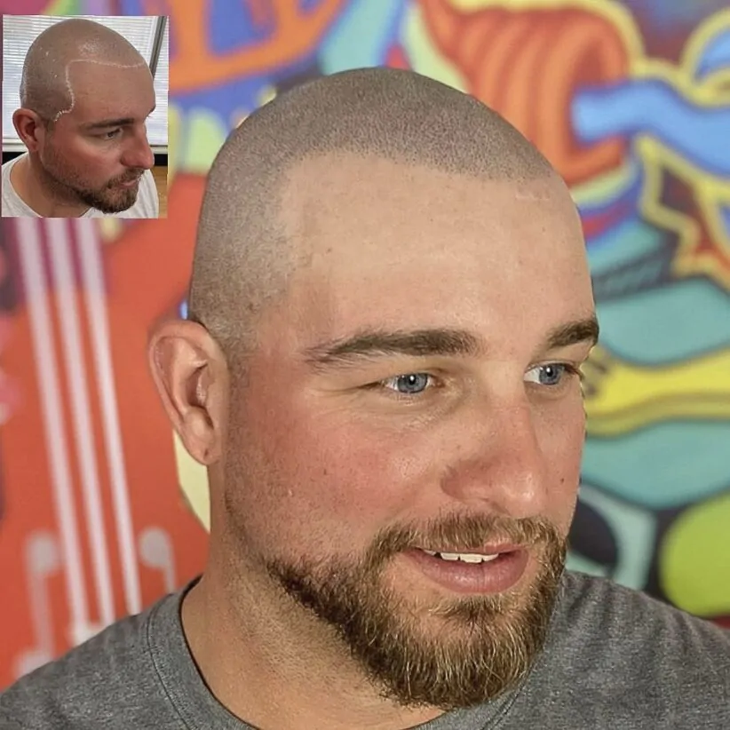 Scalp-micropigmentation-hair-loss-treatment-before-after-photo-micropigmentation-hair-tattoo-houston-tx