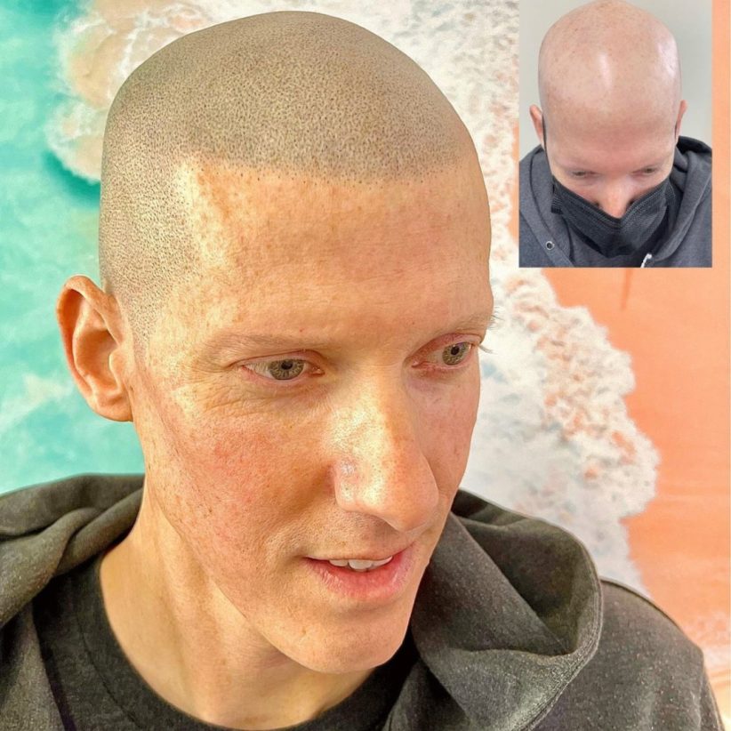 alopecia medication
