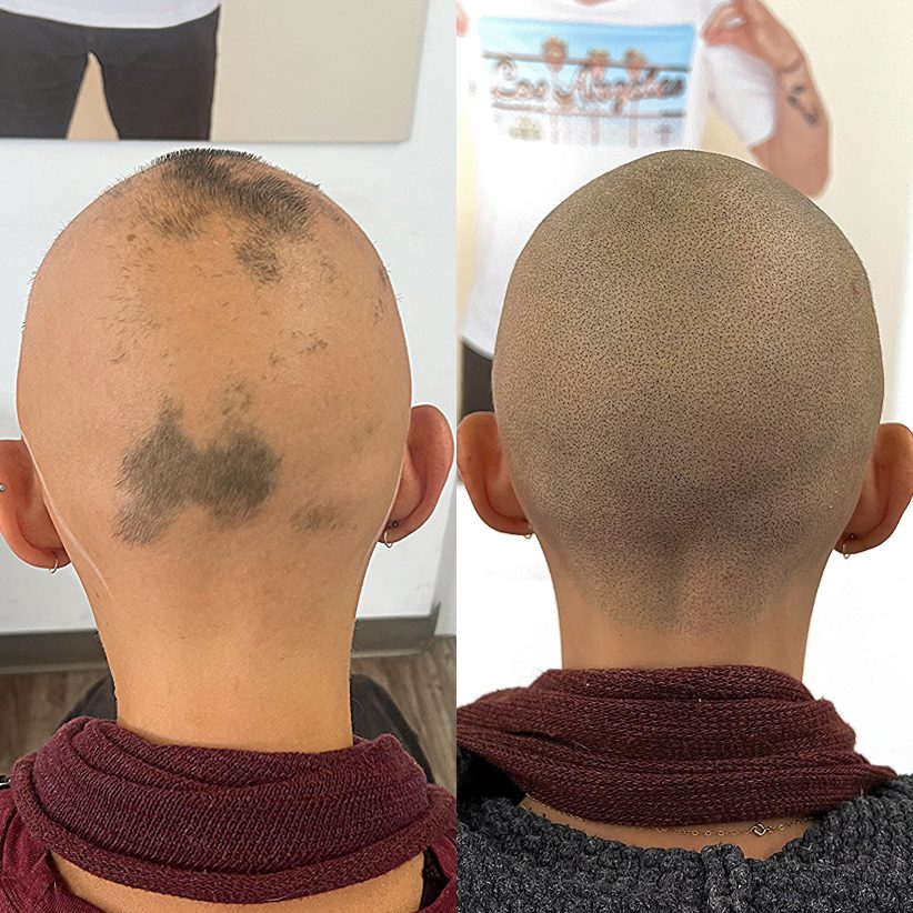 alopecia results