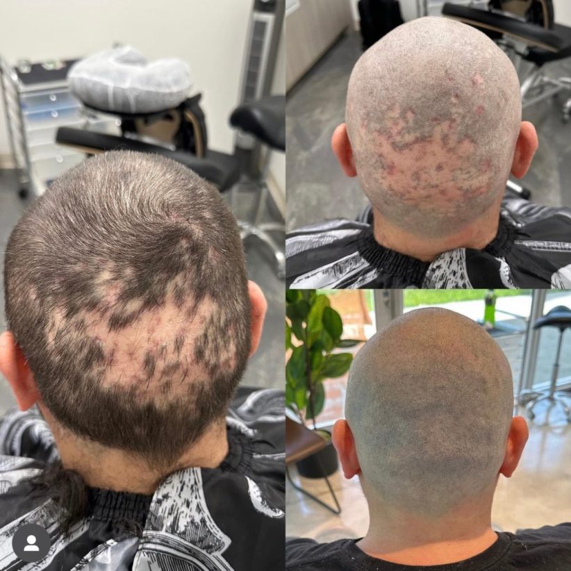 alopecia solution hair loss