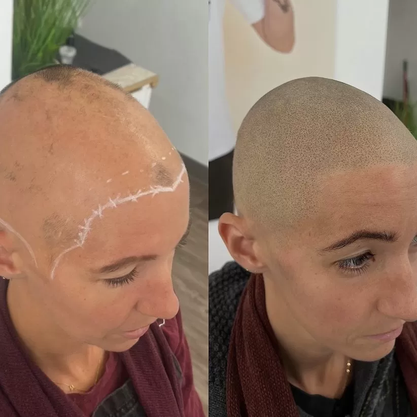 alopecia transformation