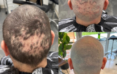 alopecia treatment smp