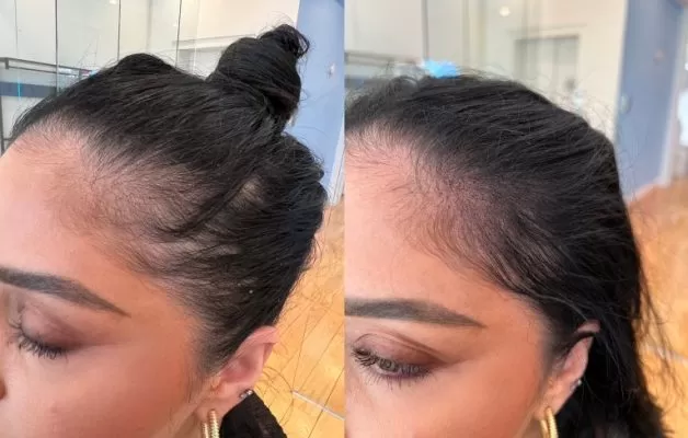 female scalp micropigmentation