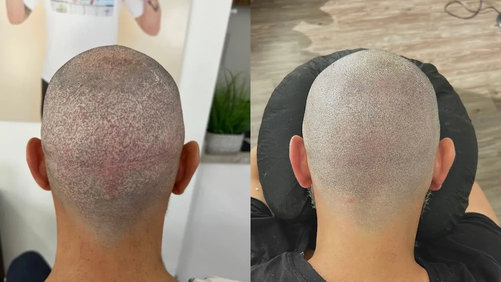 hair transplant scar