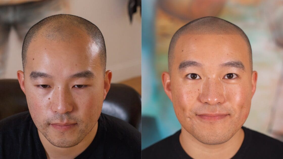 Receding Hairline Before And After