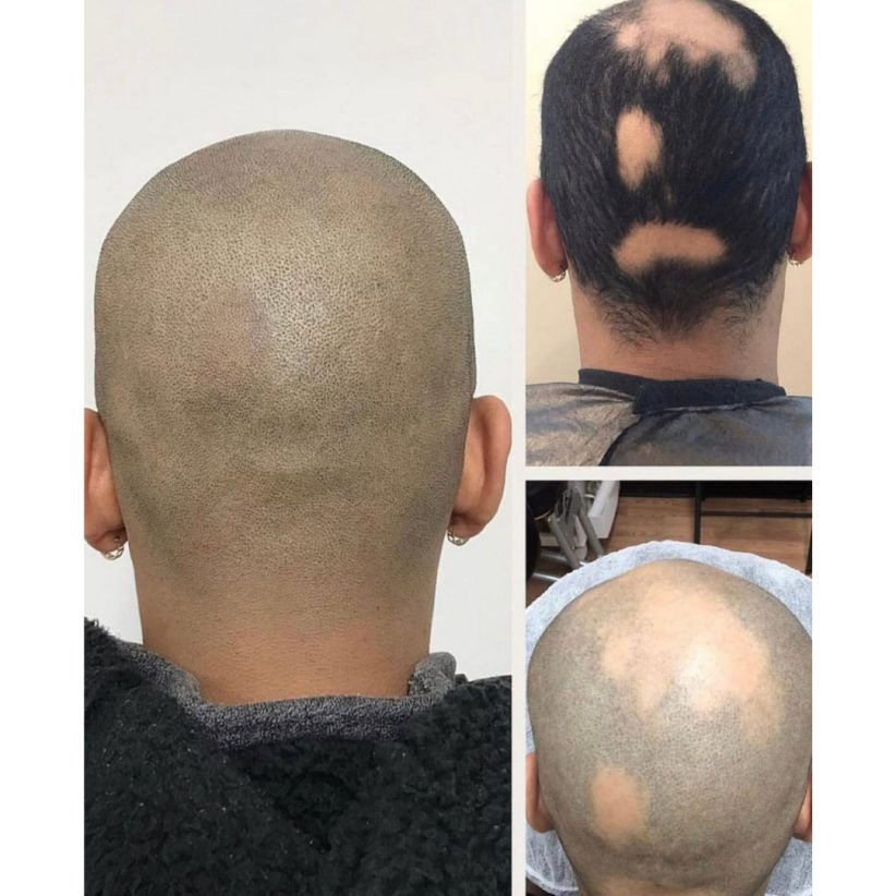 scalp micro pigmentation alopecia