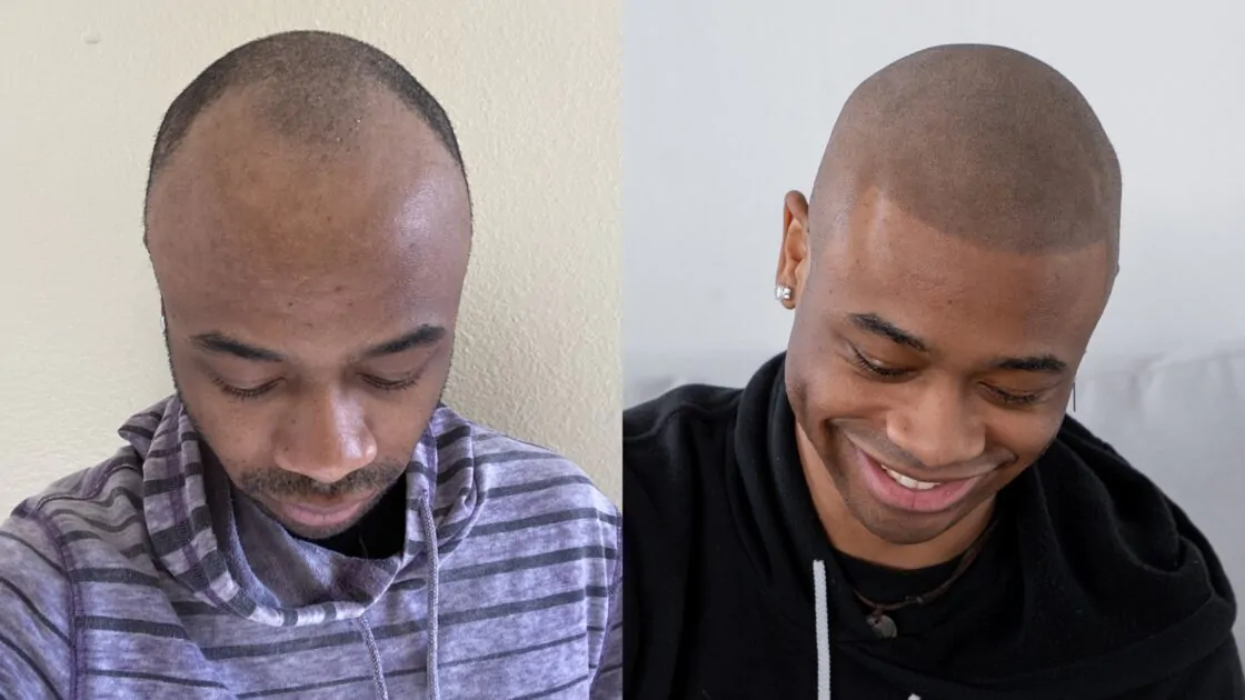 What Causes an Uneven Hairline and How can I Fix It? - Scalp Micro USA