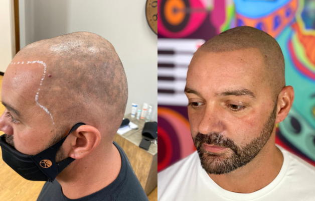 scalp micropigmentation alopecia smp