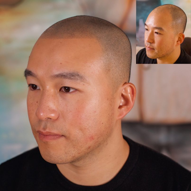 scalp micropigmentation asian man