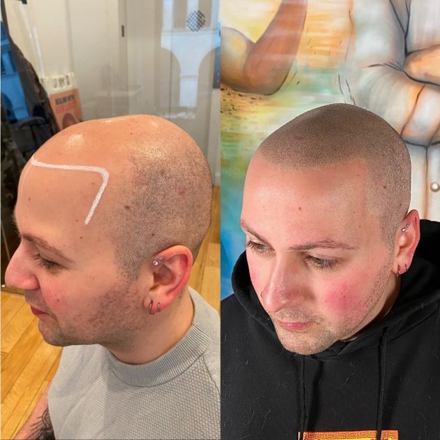 scalp micropigmentation fort lauderdale