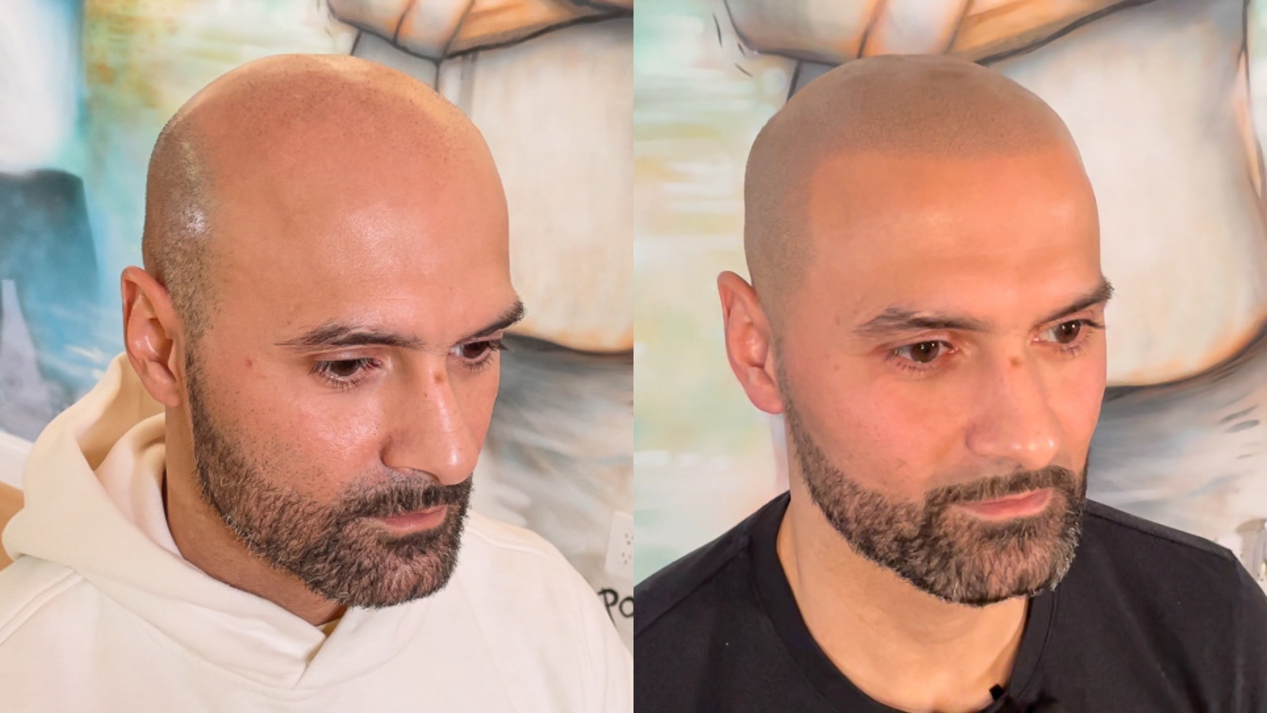 SUPER NATURAL Scalp Micropigmentation Before and After w/ Matt Iulo -  YouTube