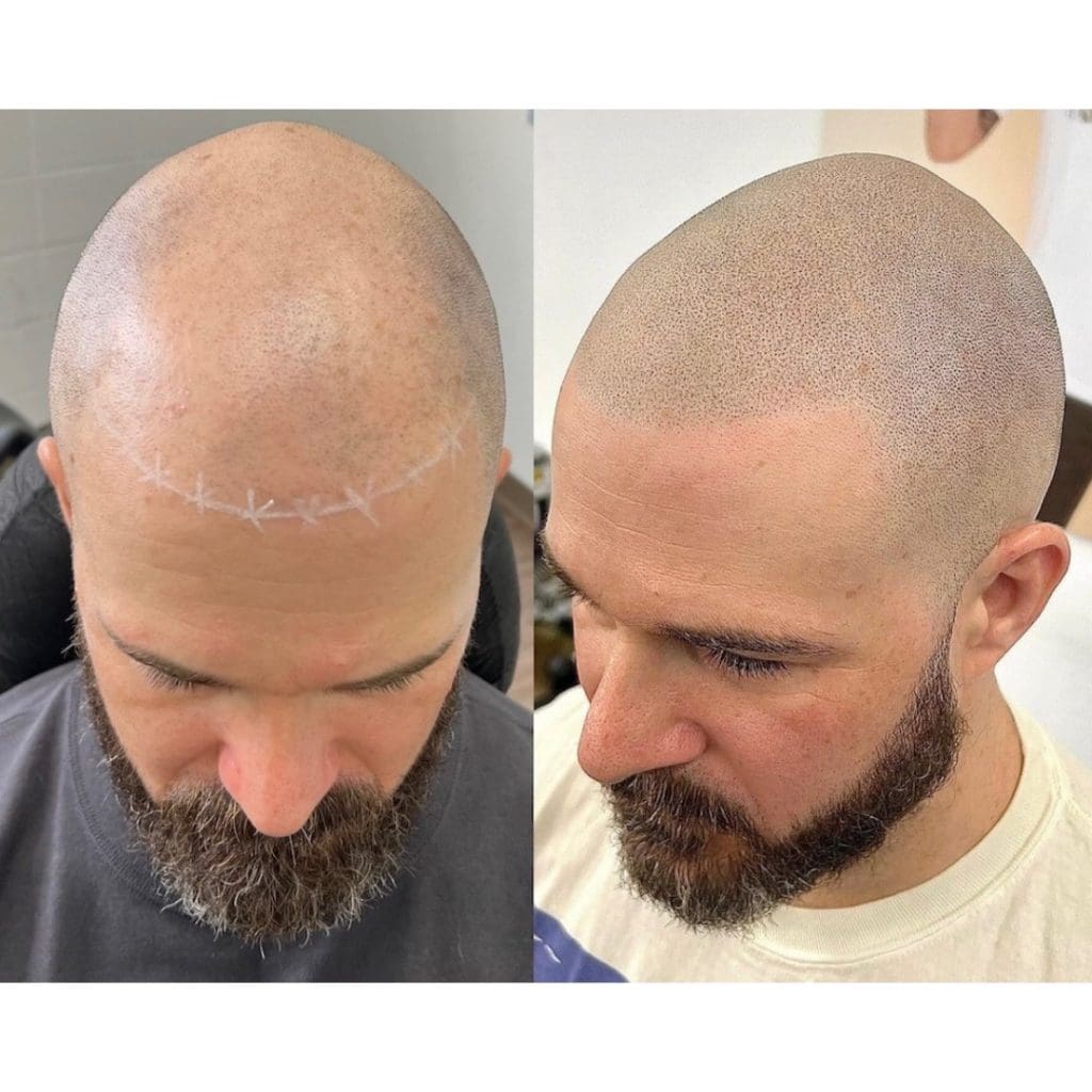 Derek Bogner Scalp Micropigmentation Los Angeles Scalp Micro USA