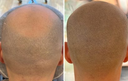 pattern baldness scalp micropigmentation