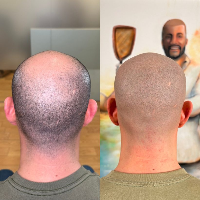 bald-crown-scalp-micropigmentation