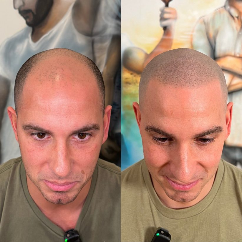 scalp-pigmentation