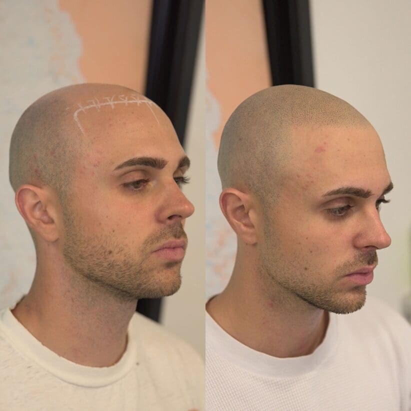 scalp micropigmentation